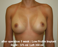 plastic-surgery-breast-augmentation